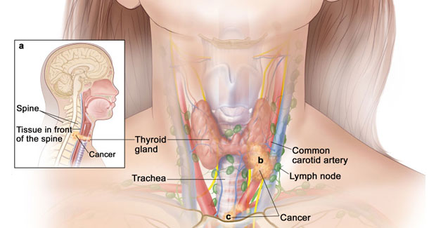 PARATHYROID-TUMORS-(ADENOMAS-&-CANCERS)